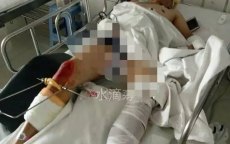 丈母娘家劈柴意外骨折，展现男子汉担当与孝心